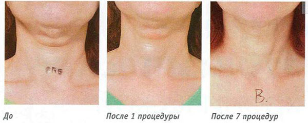 ReGen TriPolar™ подтяжка кожи и лечение целлюлита в одной системе