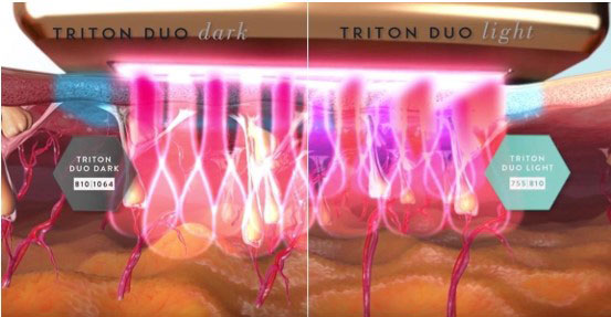 Клиническая оценка нового диодного лазера Diolaze XL, гибридного типа для удаления волос
