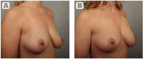 Подтяжка груди без рубцов и без скальпеля: преимущества и ограничения