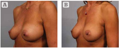Подтяжка груди без рубцов и без скальпеля: преимущества и ограничения